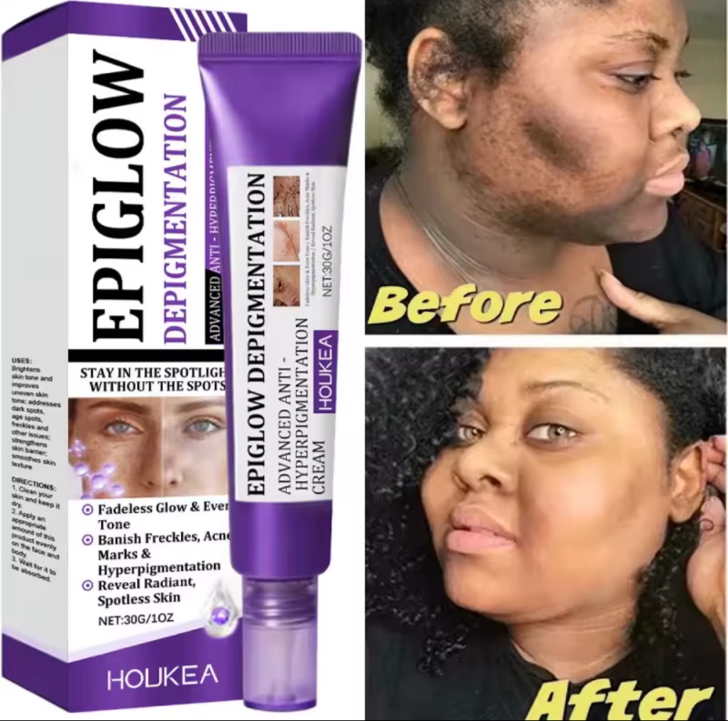 Crème éclaircissante pour le visage, Niacinamide, réduit le cloasma, mélasma, mélanine, estompe les ridules, éclaircit la peau foncée, sérum de soin